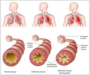 Image result for asthma airway inflammation